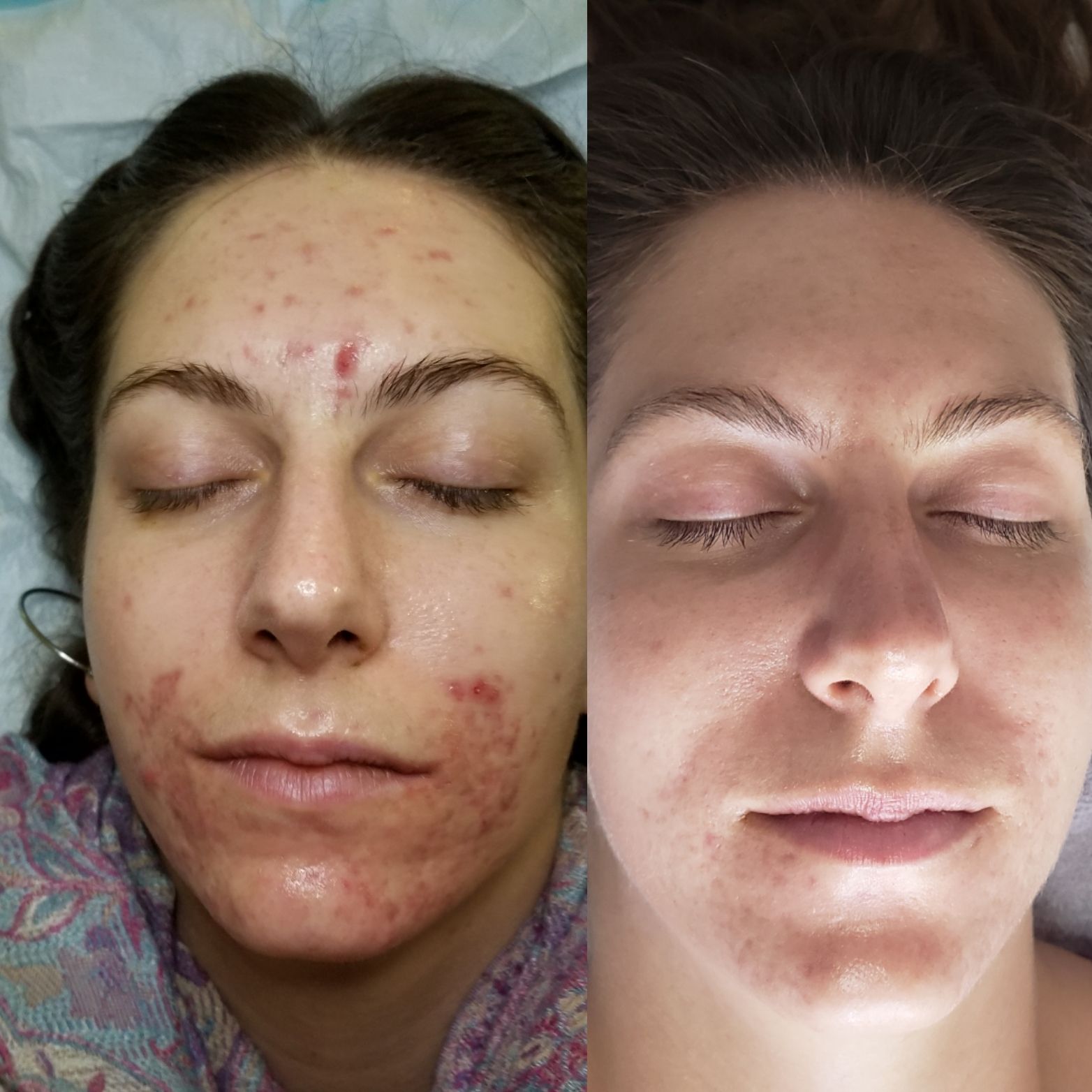 Meta Skin Acne Treatment